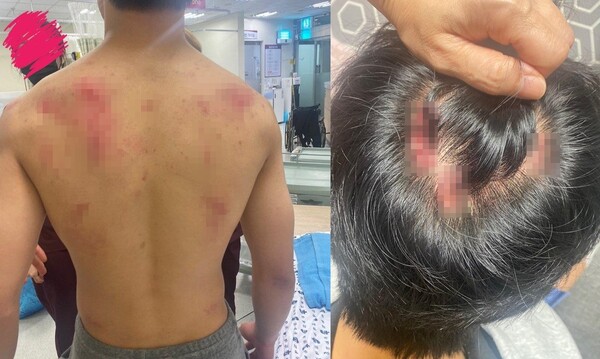 지난 5일 경찰의 과잉진압으로 상처 입은 중학생 A군의 모습. 사진=온라인 커뮤니티 '보배드림' 캡처